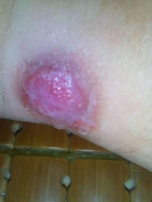 医院挖鸡眼视频,专业除鸡眼过程揭秘